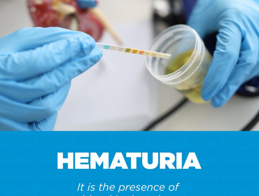 Hematuria